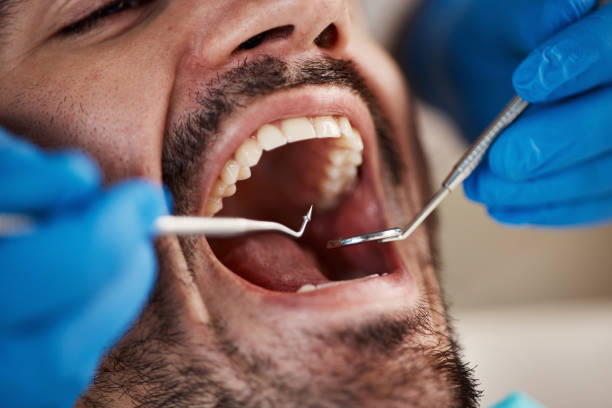 Best Chipped Tooth Repair Near Me  in Gluckstadt, MS